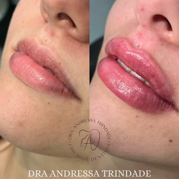 Foto 3 de Dra Andressa Trindade | Harmonização Orofacial