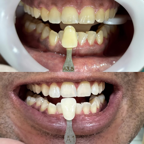 Foto 2 de Dra Any Caroline Saraiva Clareamento dental em Teresina