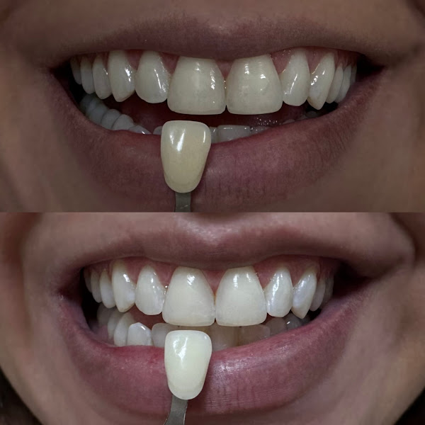 Foto 3 de Dra Any Caroline Saraiva Clareamento dental em Teresina