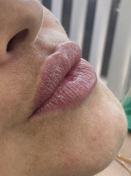 Foto 3 de Dra. Asheley Tinoco - Harmonização Facial | Campos dos Goytacazes, Rj