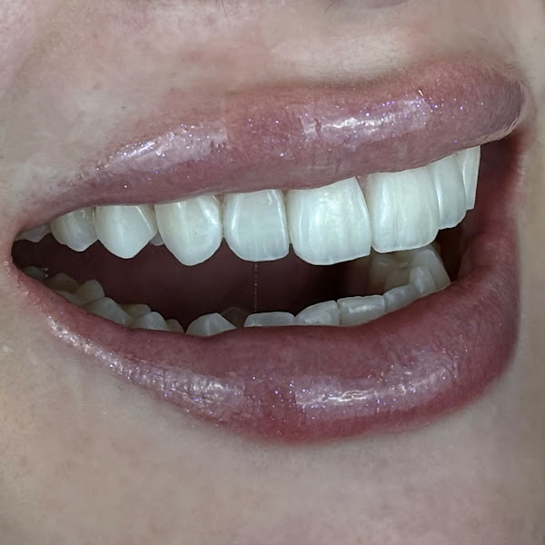 Foto 3 de Dra. Bárbara Abreu | Dentista | Lentes em Resina