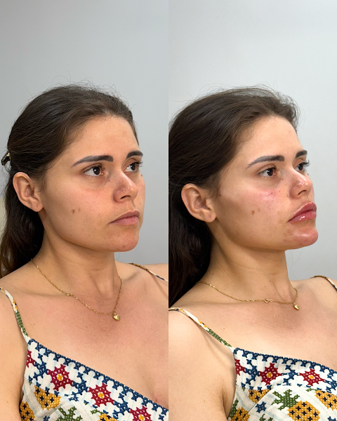 Foto 2 de Dra Bárbara Ferretti | Harmonização orofacial/ Clínico Geral
