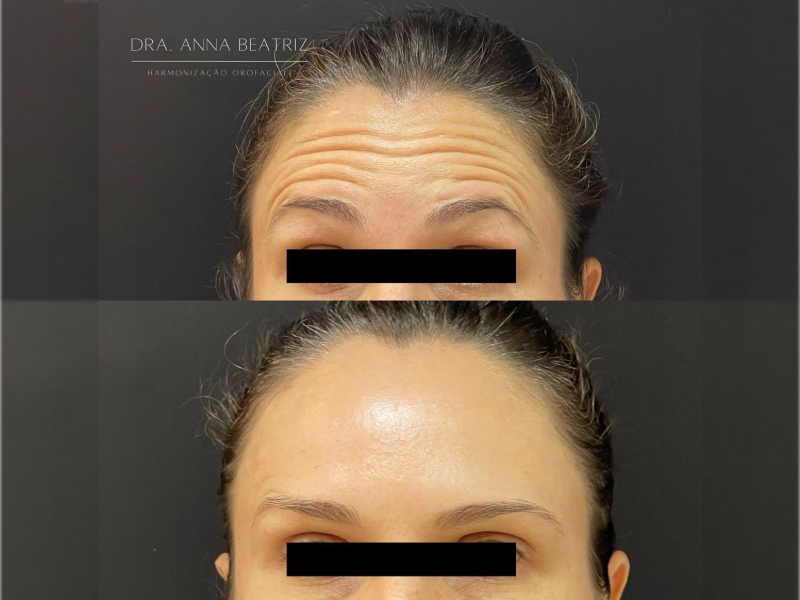 Foto 3 de Dra. Beatriz Bandeira | Harmonização Facial em Fortaleza