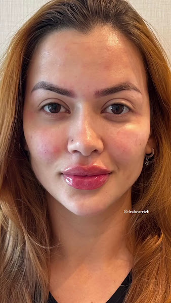 Foto 3 de Dra Beatriz Barbosa - Harmonização Facial