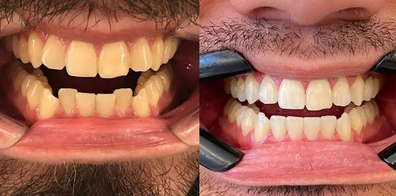 Foto 2 de Dra. Beatriz Cantarino | Dentista | Aparelho ortodôntico invisível SouSmile | Prótese Dentária