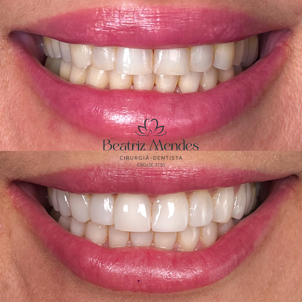 Foto 3 de Dra Beatriz Mendes | Dentista Aracaju | Faceta em resina | Clareamento