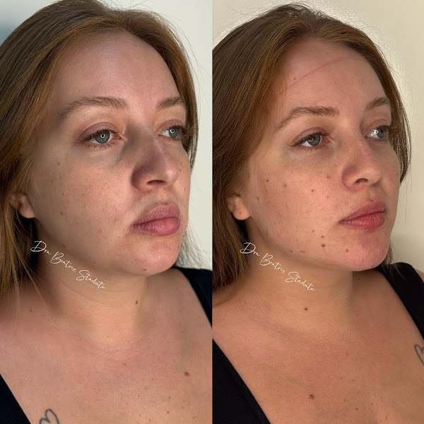 Foto 2 de Dra. Beatriz Staduto - Harmonização Facial Taubaté