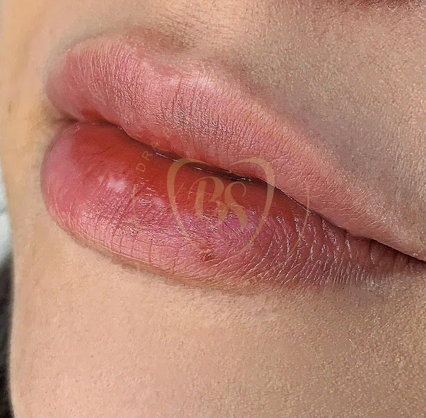 Foto 3 de Dra. Beatriz Staduto - Harmonização Facial Taubaté