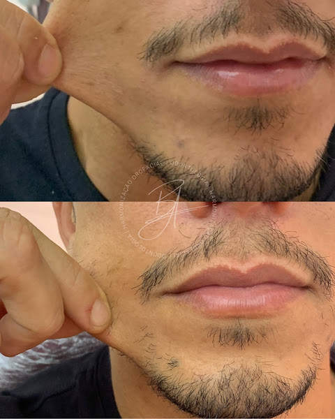 Foto 3 de Dra Bianca Araújo - Harmonização facial em Copacabana