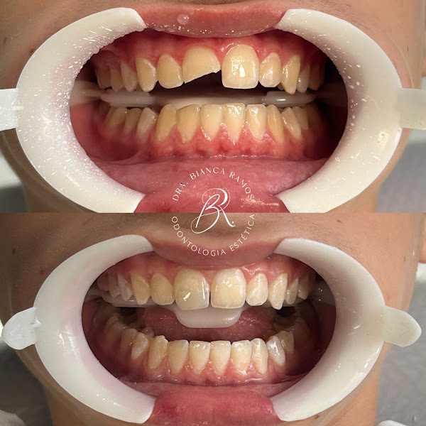 Foto 2 de Dra. Bianca Ramos, Facetas e Harmonização facial