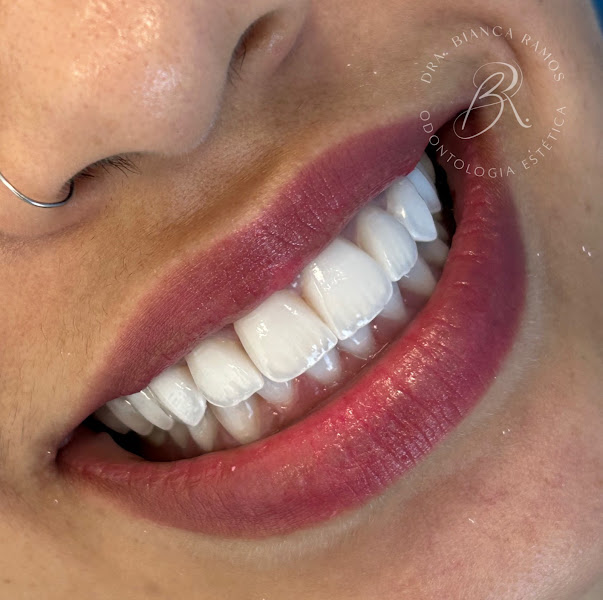 Foto 3 de Dra. Bianca Ramos, Facetas e Harmonização facial