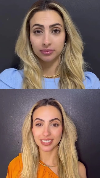 Foto 2 de Dra Brenda Moreira | Botox | Bioestimulador de Colageno | Preenchimento Labial
