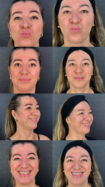 Foto 3 de Dra. Bruna Morais Harmonização Orofacial e Odontologia Especializada
