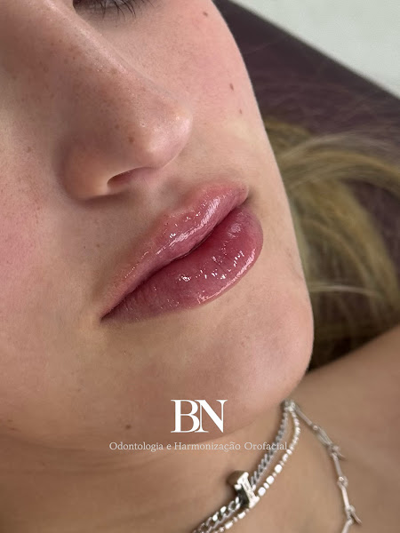Foto 3 de Dra. Bruna Nascimento | Harmonização Orofacial e Odontologia