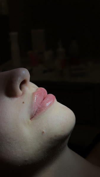 Foto 2 de Dra Bruna Sacomani- Harmonização Orofacial