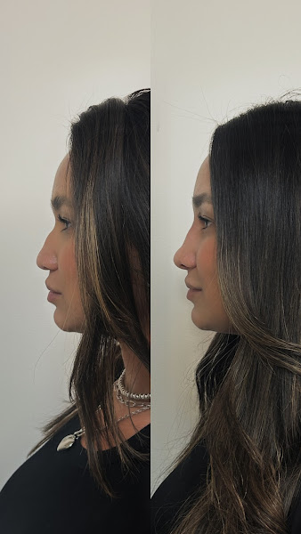 Foto 3 de Dra Bruna Sacomani- Harmonização Orofacial