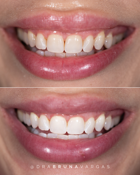 Foto 3 de Dra Bruna Vargas Dentista Facetas e Clareamento São José