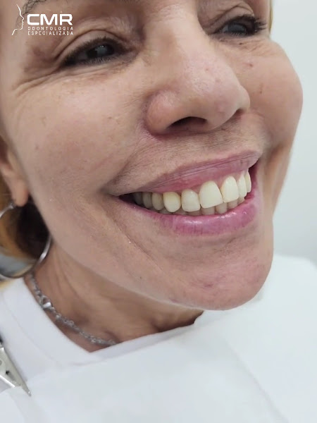 Foto 3 de Dra Camila Canellas - CMR Odontologia - Lente Contato Dental | Implante Dentário