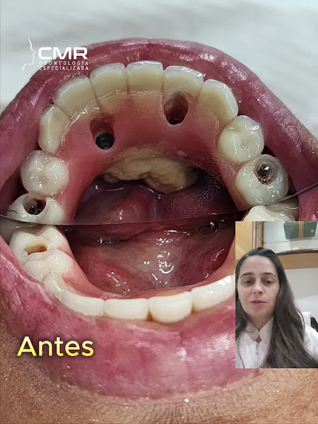 Foto 4 de Dra Camila Canellas - CMR Odontologia - Lente Contato Dental | Implante Dentário