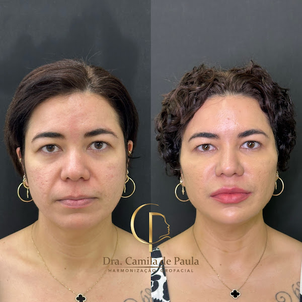 Foto 2 de Dra. Camila de Paula - Harmonização Orofacial