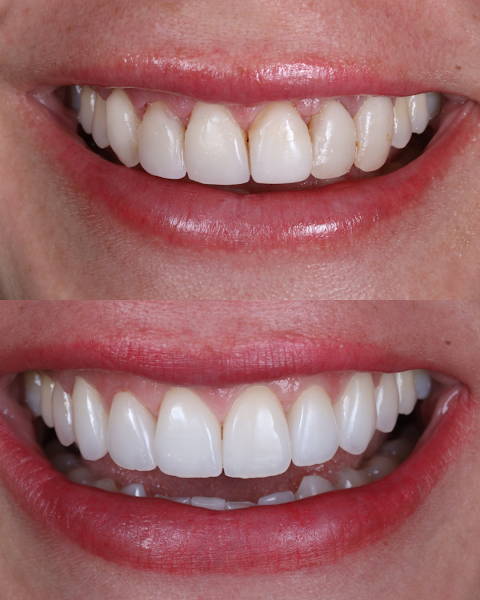 Foto 3 de Dra Camila Fornari | Clínica Odontologia Bas | Lentes de contato dental em Apucarana - PR