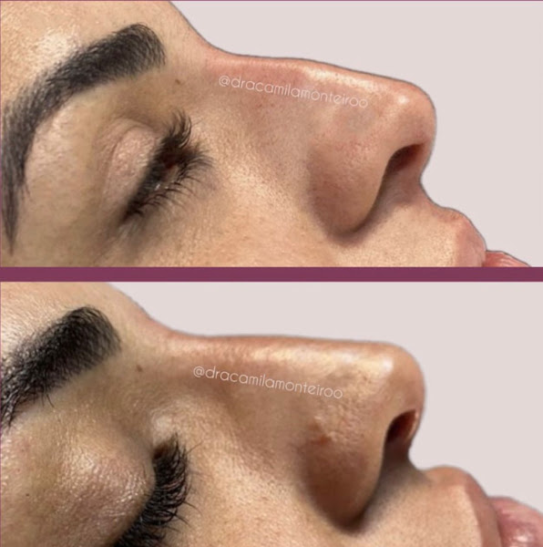 Foto 3 de Dra. Camila Monteiro - Harmonização Facial Campos dos Goytacazes