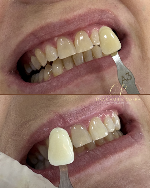 Foto 3 de Dra Camila Rasera | Harmonização Orofacial CRO-SP 169168