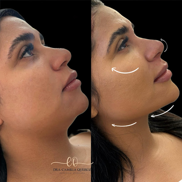 Foto 3 de Dra. Camilla Queiroz | Harmonização Facial