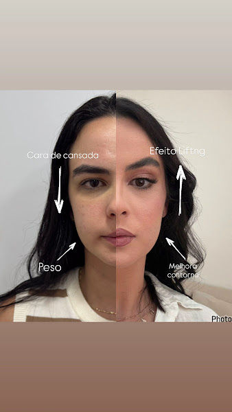 Foto 2 de Dra. Carina Altoé Ogioni - Harmonização Orofacial