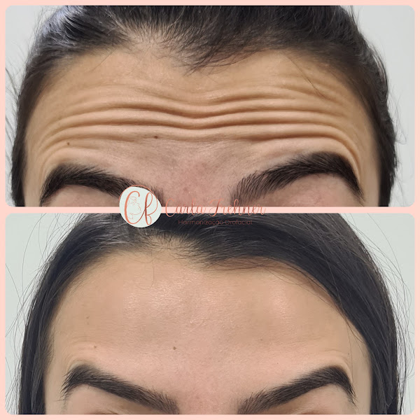 Foto 3 de Dra Carla Frehner - Harmonização Facial Botox Preenchimento Bioestimulador de Colágeno Fios de PDO - SBC