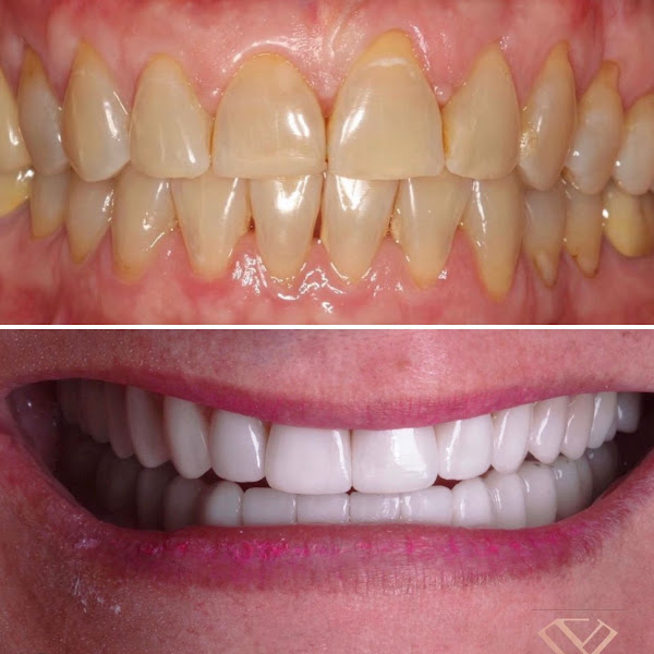 Foto 2 de Dra. Carla Merlo - Facetas em resina e porcelana - ORAL VIP ODONTOLOGIA