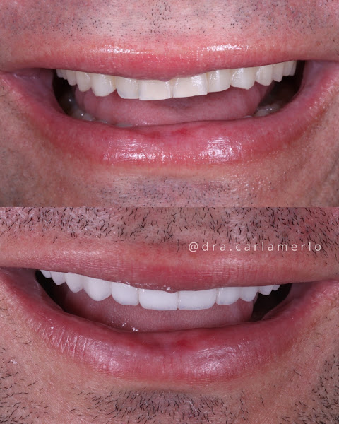 Foto 3 de Dra. Carla Merlo - Facetas em resina e porcelana - ORAL VIP ODONTOLOGIA
