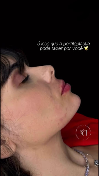Foto 2 de Dra. Carolina Andrade - Preenchimento Labial em Recife | Harmonização Facial em Recife