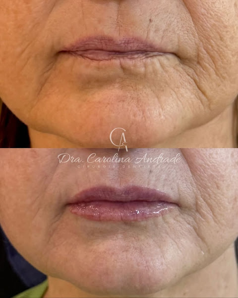 Foto 3 de Dra. Carolina Andrade - Preenchimento Labial em Recife | Harmonização Facial em Recife