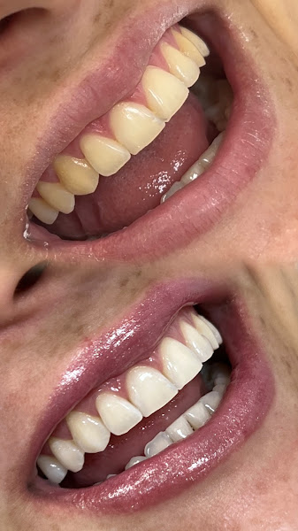 Foto 3 de Dra. Carolina Magalhães | Lentes em Resina e Porcelana | Dentista no Recreio