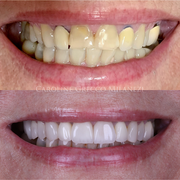 Foto 2 de Dra Caroline Grecco Milanezi - Odontologia | Lentes de contato dental