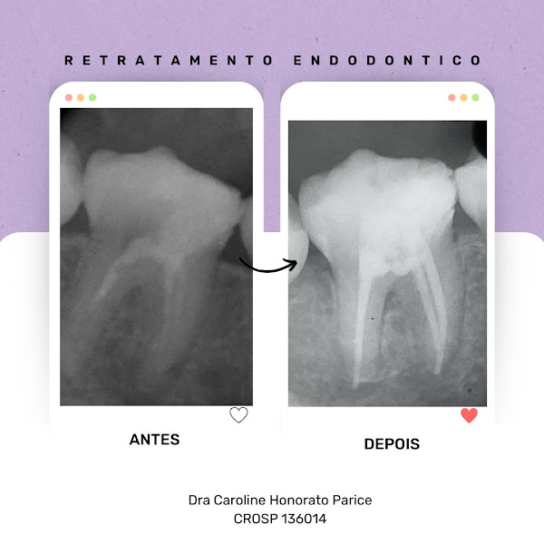 Foto 3 de Dra. Caroline Honorato Parice - Dentista especialista em canal / Endodontista