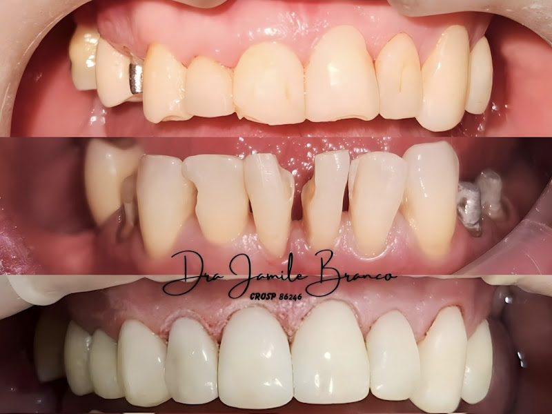 Foto 8 de Dra Caroline Neder |Dentista em Jundiaí| |Invisalign em Jundiaí| |Lentes de porcelana em Jundiaí|
