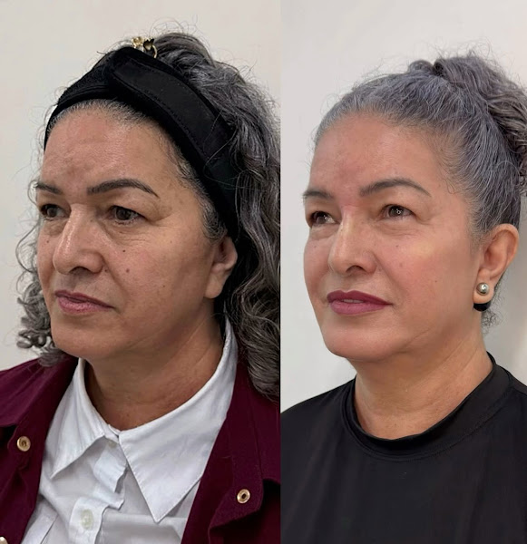 Foto 4 de Dra Caroline Pereira Harmonização Facial - Itaquaquecetuba