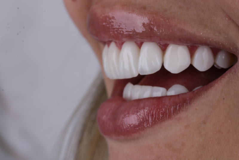 Foto 2 de Dra. Caroline Tigre • Lentes em resina & Porcelana