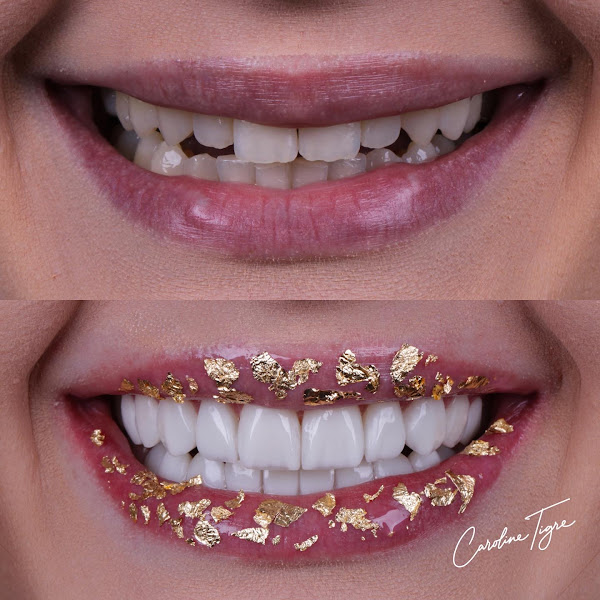 Foto 3 de Dra. Caroline Tigre • Lentes em resina & Porcelana