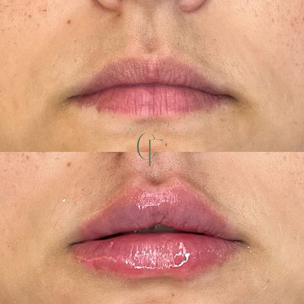 Foto 3 de Dra. Clara Freire - Harmonização Facial