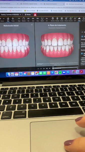 Foto 3 de Dra. Clarice Pillon | Invisalign | Botox | Harmonização Orofacial