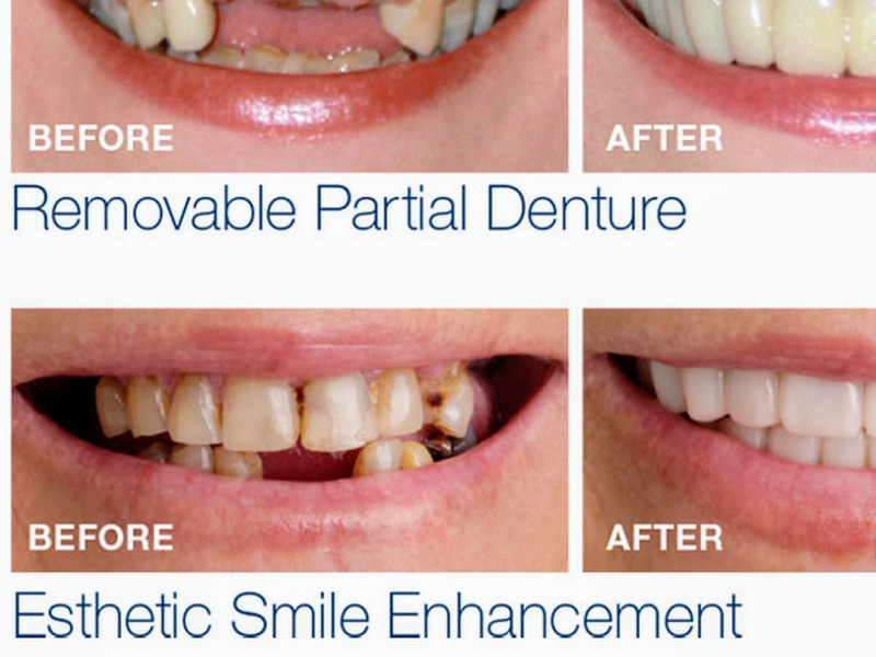 Foto 7 de Dra Cláudia Borges - Implantes Dentários - Carga Imediata - Protocolo - Prótese Dentária - Especialista em Implante