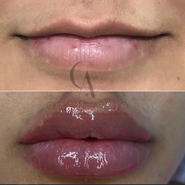 Foto 2 de Dra. Cleyjane Araújo - Harmonização facial