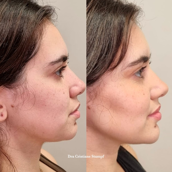 Foto 3 de Dra Cristiane Andreolla Stumpf Harmonização OroFacial e alinhadores Invisiveis em Curitiba