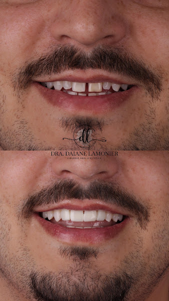 Foto 3 de Dra. Daiane Lamonier (CLÍNICA LAMONIER) - Harmonização Facial | Lipo de Papada | Lentes e Facetas | Implantes e Alinhadores