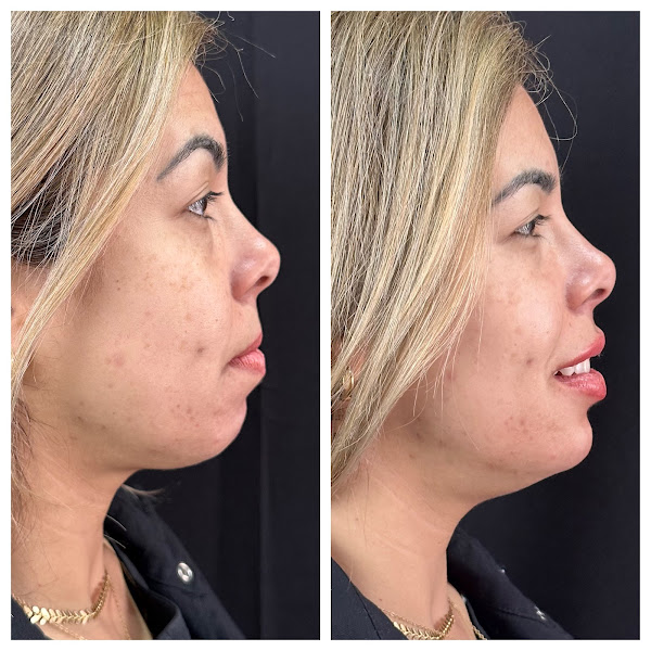 Foto 3 de Dra Daniela Shibuya | Harmonização Orofacial