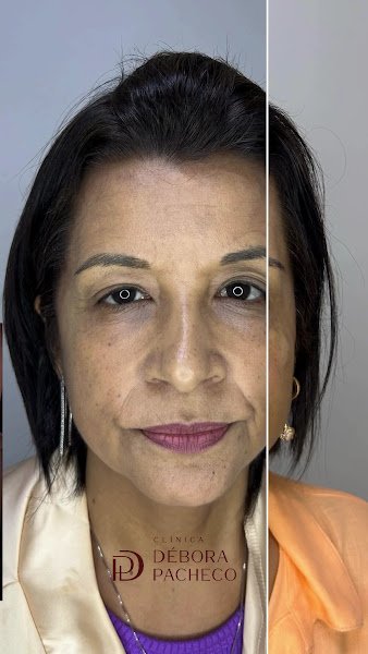 Foto 3 de Dra Débora Pacheco - Preenchimento - Rejuvenescimento Facial - Tratamento de Melasma em Guarulhos