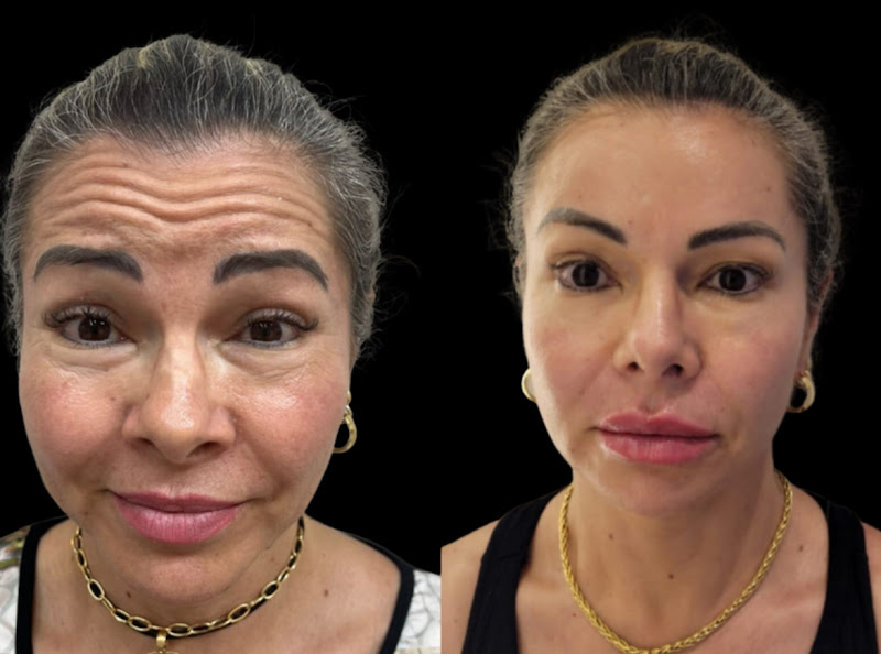 Foto 3 de Dra. Débora Sartori | Preenchimento Labial, Botox, Fios de PDO, Harmonização Facial, Bioestimulador de Colágeno em Canoas